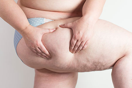 Lipoedeem Lipoedeem aandoening te behandelen met Oedeemtherapie