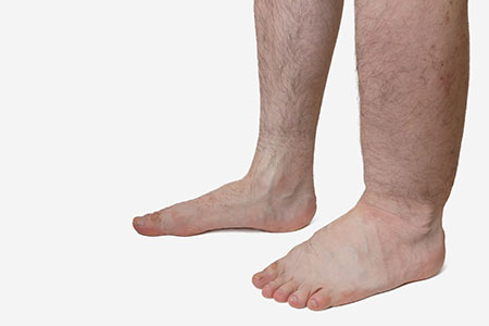 Lymfoedeem Lymfoedeem aandoening te behandelen met Oedeemtherapie