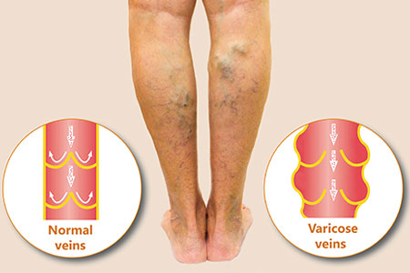 Veneus Oedeem Veneus Oedeem aandoening te behandelen met Oedeemtherapie