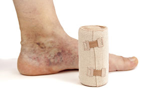 zwachtelen Zwachtelen is een behandeling die kan worden toegepast bij oedeemtherapie