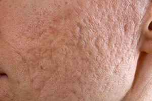 Acne Littekens