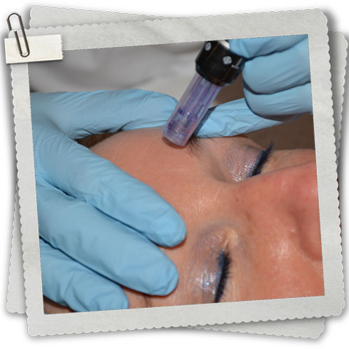 Aanvraagformulier micro needling behandeling